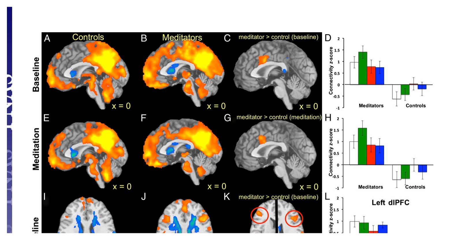 Figura do estudo Brewer 2011, Yale, mapas de ressonancia cerebral comparando praticantes e iniciantes